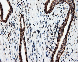 MCL1 / MCL 1 Antibody - Immunohistochemical staining of paraffin-embedded Carcinoma of prostate tissue using anti-MCL1 mouse monoclonal antibody. (Dilution 1:50).