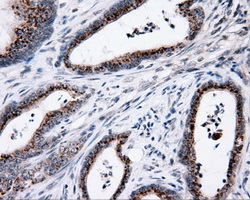 MCL1 / MCL 1 Antibody - IHC of paraffin-embedded Adenocarcinoma of colon tissue using anti-MCL1 mouse monoclonal antibody. (Dilution 1:50).