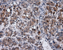 MCL1 / MCL 1 Antibody - IHC of paraffin-embedded Carcinoma of liver tissue using anti-MCL1 mouse monoclonal antibody. (Dilution 1:50).