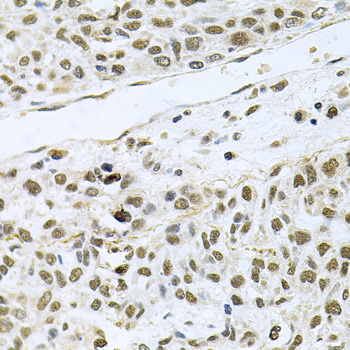 MCL1 / MCL 1 Antibody - Immunohistochemistry of paraffin-embedded human lung cancer using MCL1 antibodyat dilution of 1:100 (40x lens).