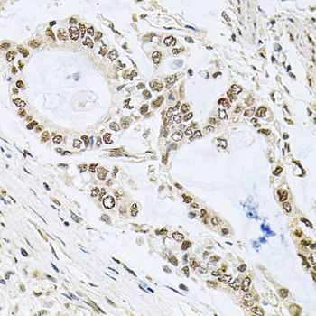 MCL1 / MCL 1 Antibody - Immunohistochemistry of paraffin-embedded human gastric cancer using MCL1 antibodyat dilution of 1:100 (40x lens).
