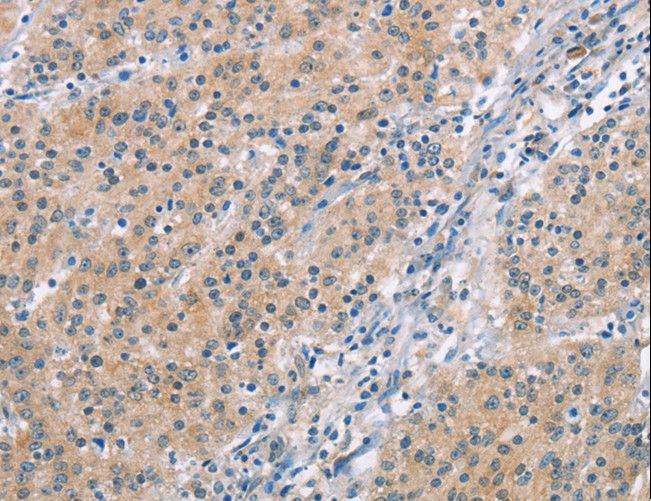 MCL1 / MCL 1 Antibody - Immunohistochemistry of paraffin-embedded Human thyroid cancer using MCL1 Polyclonal Antibody at dilution of 1:60.