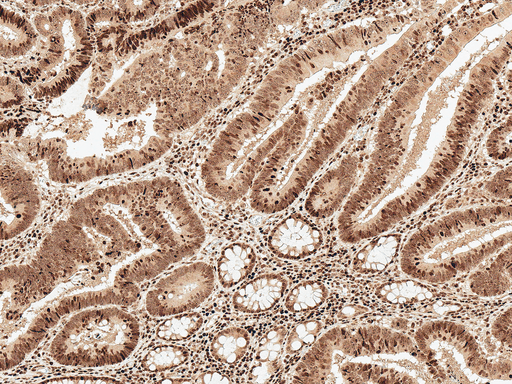 MCL1 / MCL 1 Antibody - Immunohistochemistry analysis using Rabbit Anti-MCL 1 Polyclonal Antibody. Tissue: Colon Cancer. Species: Human. Fixation: Formalin Fixed Paraffin-Embedded. Primary Antibody: Rabbit Anti-MCL 1 Polyclonal Antibody  at 1:50 for 30 min at RT. Counterstain: Hematoxylin. Magnification: 10X. HRP-DAB Detection.