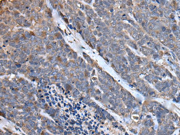 MCM10 Antibody - Immunohistochemistry of paraffin-embedded Human thyroid cancer tissue  using MCM10 Polyclonal Antibody at dilution of 1:50(×200)