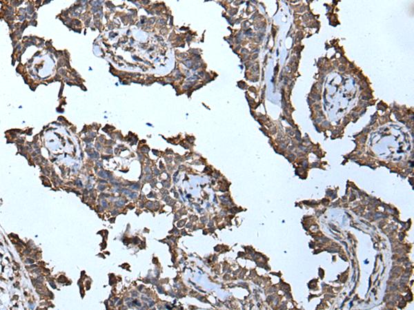 MCM10 Antibody - Immunohistochemistry of paraffin-embedded Human ovarian cancer tissue  using MCM10 Polyclonal Antibody at dilution of 1:50(×200)