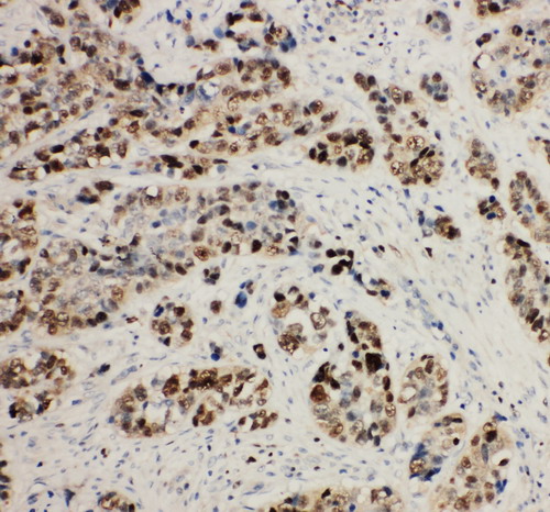 MCM2 Antibody - MCM2 antibody. IHC(P): Human Lung Cancer Tissue.