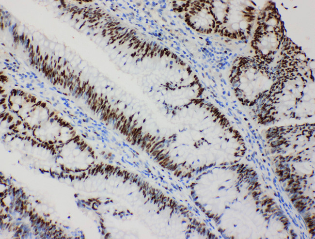 MCM2 Antibody - MCM2 antibody. IHC(P): Human Intestinal Cancer Tissue.