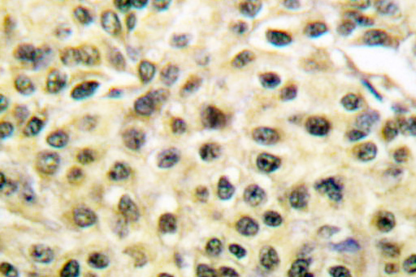 MCM2 Antibody - IHC of MCM2 (A11) pAb in paraffin-embedded human breast carcinoma tissue.