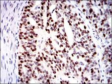MCM2 Antibody - IHC of paraffin-embedded ovarian cancer tissues using MCM2 mouse monoclonal antibody with DAB staining.