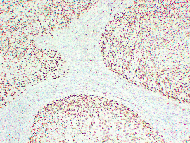 MCM2 Antibody - Cervical Squamous Carcinoma