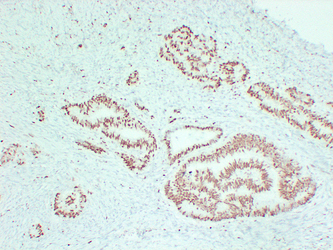 MCM2 Antibody - Colon Carcinoma 1