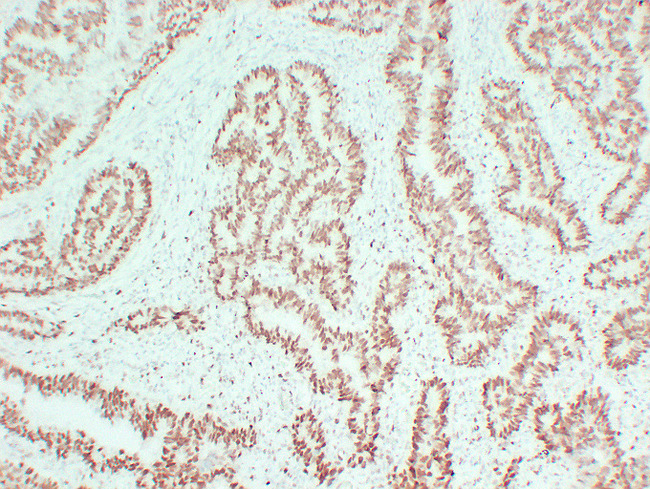 MCM2 Antibody - Colon Carcinoma 2