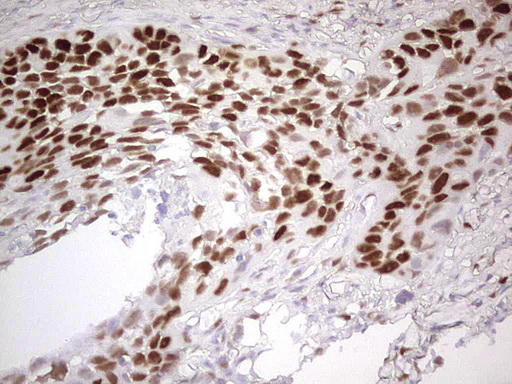 MCM2 Antibody - Immunohistochemical staining of paraffin-embedded Carcinoma of Human kidney tissue using anti-MCM2 mouse monoclonal antibody. (Heat-induced epitope retrieval by 1 mM EDTA in 10mM Tris, pH8.5, 120C for 3min,