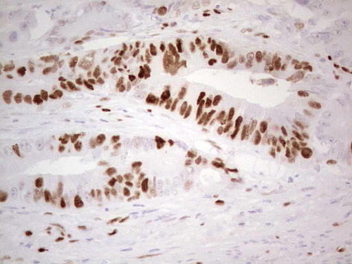 MCM2 Antibody - IHC of paraffin-embedded Adenocarcinoma of Human colon tissue using anti-MCM2 mouse monoclonal antibody. (Heat-induced epitope retrieval by 1 mM EDTA in 10mM Tris, pH8.5, 120°C for 3min).