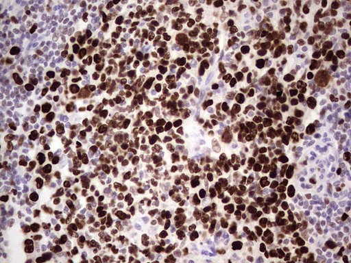 MCM2 Antibody - IHC of paraffin-embedded Carcinoma of Human lung tissue using anti-MCM2 mouse monoclonal antibody. (Heat-induced epitope retrieval by 1 mM EDTA in 10mM Tris, pH8.5, 120°C for 3min).