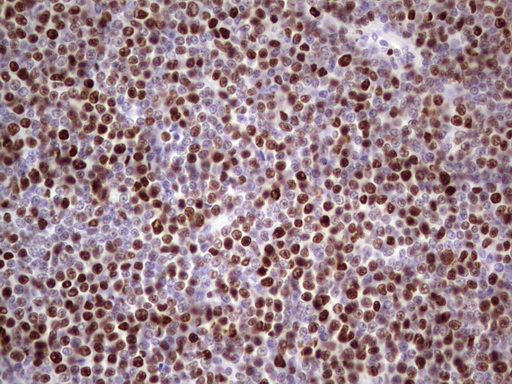 MCM2 Antibody - IHC of paraffin-embedded Human lymphoma tissue using anti-MCM2 mouse monoclonal antibody. (Heat-induced epitope retrieval by 1 mM EDTA in 10mM Tris, pH8.5, 120°C for 3min).