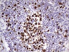 MCM2 Antibody - Immunohistochemical staining of paraffin-embedded Carcinoma of Human lung tissue using anti-MCM2 mouse monoclonal antibody. (Heat-induced epitope retrieval by 1 mM EDTA in 10mM Tris, pH8.5, 120C for 3min,
