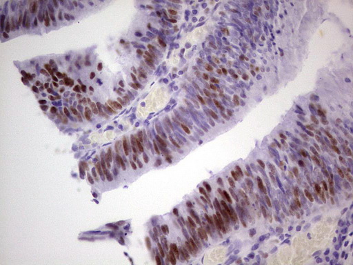 MCM2 Antibody - Immunohistochemical staining of paraffin-embedded Adenocarcinoma of Human colon tissue using anti-MCM2 mouse monoclonal antibody. (Heat-induced epitope retrieval by 1 mM EDTA in 10mM Tris, pH8.5, 120C for 3min,
