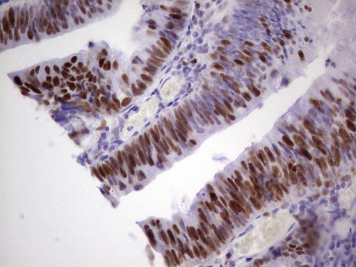 MCM2 Antibody - Immunohistochemical staining of paraffin-embedded Adenocarcinoma of Human colon tissue using anti-MCM2 mouse monoclonal antibody. (Heat-induced epitope retrieval by 1 mM EDTA in 10mM Tris, pH8.5, 120C for 3min,