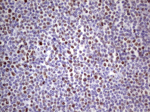 MCM2 Antibody - IHC of paraffin-embedded Human lymphoma tissue using anti-MCM2 mouse monoclonal antibody. (Heat-induced epitope retrieval by 1 mM EDTA in 10mM Tris, pH8.5, 120°C for 3min).