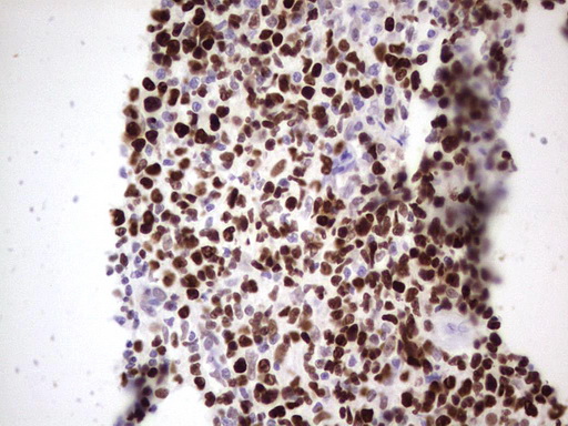 MCM2 Antibody - Immunohistochemical staining of paraffin-embedded Carcinoma of Human lung tissue using anti-MCM2 mouse monoclonal antibody. (Heat-induced epitope retrieval by 1 mM EDTA in 10mM Tris, pH8.5, 120C for 3min,