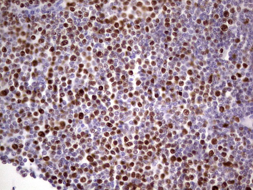 MCM2 Antibody - Immunohistochemical staining of paraffin-embedded Human lymphoma tissue using anti-MCM2 mouse monoclonal antibody. (Heat-induced epitope retrieval by 1 mM EDTA in 10mM Tris, pH8.5, 120C for 3min,