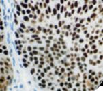 MCM2 Antibody - IHC of MCM-2 on FFPE HSIL of the Cervix.