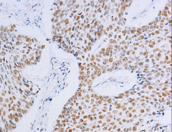 MCM2 Antibody - Immunohistochemistry of paraffin-embedded Human lung cancer using MCM2 Polyclonal Antibody at dilution of 1:20.
