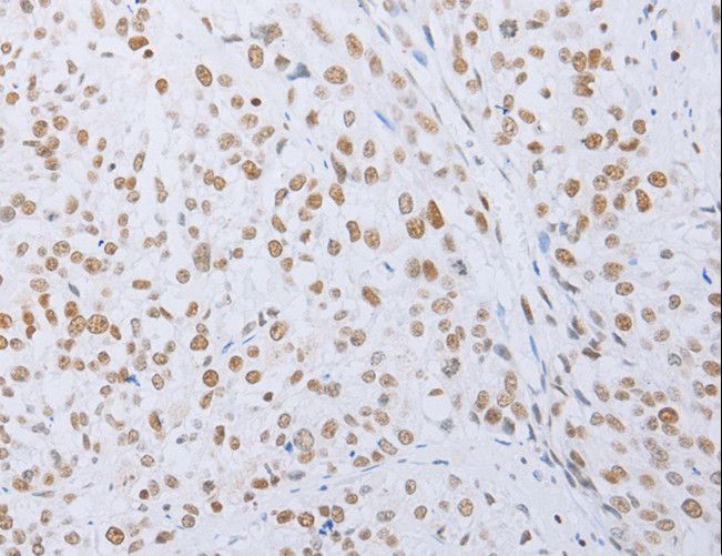 MCM2 Antibody - Immunohistochemistry of paraffin-embedded Human esophagus cancer using MCM2 Polyclonal Antibody at dilution of 1:50.