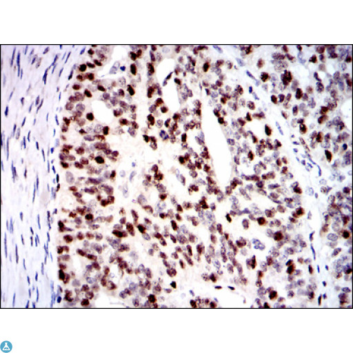 MCM2 Antibody - Immunohistochemistry (IHC) analysis of paraffin-embedded ovarian cancer tissues with DAB staining using BM28 Monoclonal Antibody.