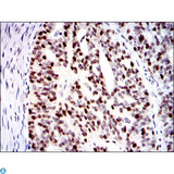 MCM2 Antibody - Immunohistochemistry (IHC) analysis of paraffin-embedded ovarian cancer tissues with DAB staining using BM28 Monoclonal Antibody.