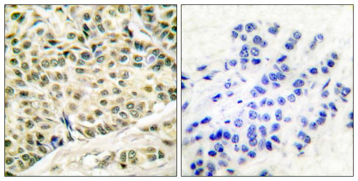 MCM2 Antibody - Peptide - + Immunohistochemical analysis of paraffin-embedded human breast carcinoma tissue using MCM2 antibody.