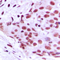 MCM2 Antibody - Immunohistochemical analysis of MCM2 staining in human breast cancer formalin fixed paraffin embedded tissue section. The section was pre-treated using heat mediated antigen retrieval with sodium citrate buffer (pH 6.0). The section was then incubated with the antibody at room temperature and detected using an HRP conjugated compact polymer system. DAB was used as the chromogen. The section was then counterstained with hematoxylin and mounted with DPX.