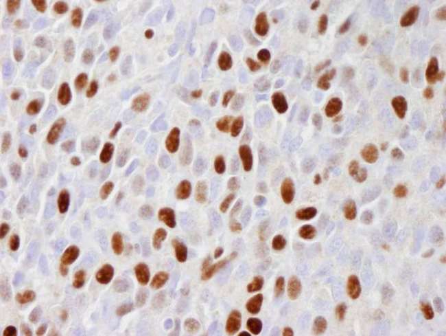 MCM2 Antibody - Detection of Mouse phospho-MCM2 (Ser 108) by Immunohistochemistry. Sample: FFPE section of mouse squamous cell carcinoma. Antibody: Affinity purified rabbit anti-Phospho-MCM2 (Ser 108) used at a dilution of 1:100. Detection: DAB.