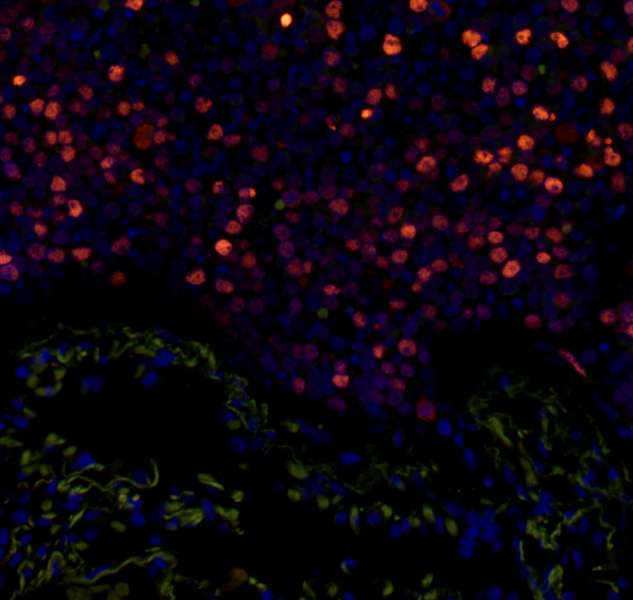 MCM2 Antibody - Detection of Human Phospho MCM2 (Ser 108) by Immunohistochemistry. Sample: FFPE section of human small cell lung cancer. Antibody: Affinity purified rabbit anti-Phospho-MCM2 (Ser 108) used at a dilution of 1:100. Detection: Red-fluorescent Alexa Fluor 555 goat anti-rabbit IgG (Invitrogen) used at a dilution of 1:500.