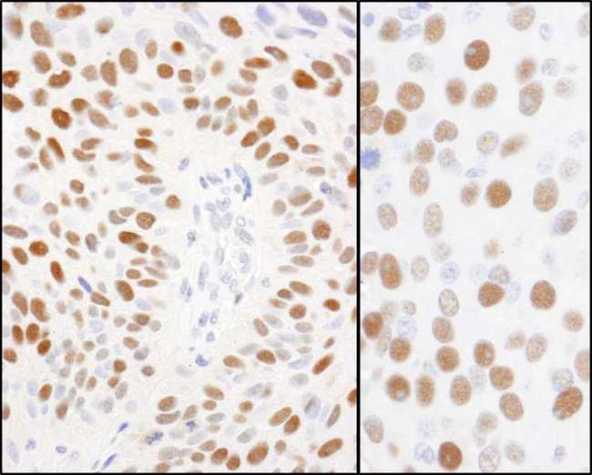 MCM2 Antibody - Detection of Human and Mouse Phospho MCM2 (S108) by Immunohistochemistry. Sample: FFPE sections of human breast carcinoma (left) and mouse renal cell carcinoma (right). Antibody: Affinity purified rabbit anti-phospho MCM2 (S108) used at a dilution of 1:5000 (0.2 ug/ml). Detection: DAB.