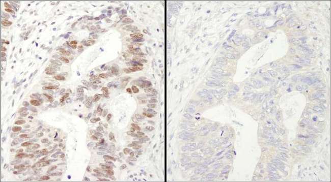 MCM2 Antibody - Detection of Human Phospho MCM2 (S40/S41) by Immunohistochemistry. Samples: FFPE serial sections of human colon adenocarcinoma. Mock phosphatase treated section (left) or calf intestinal phosphatase-treated section (right) immunostained for Phospho MCM2 (S40/S41). Antibody: Affinity purified rabbit anti-Phospho MCM2 (S40/S41) used at a dilution of 1:250. Detection: DAB staining using anti-Rabbit IHC antibody at a dilution of 1:100.