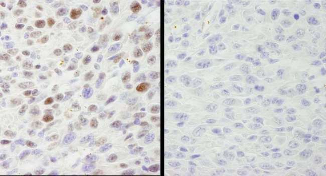 MCM2 Antibody - Detection of Mouse Phospho MCM2 (S40/S41) by Immunohistochemistry. Samples: FFPE serial sections of mouse squamous cell carcinoma. Mock phosphatase treated section (left) or calf intestinal phosphatase-treated section (right) immunostained for Phospho MCM2 (S40/S41). Antibody: Affinity purified rabbit anti-Phospho MCM2 (S40/S41) used at a dilution of 1:250. Detection: DAB staining using anti-Rabbit IHC antibody at a dilution of 1:100.