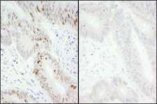 MCM2 Antibody - Detection of Human Phospho MCM2 (S40/S41) by Immunohistochemistry. Samples: FFPE serial sections of human colon carcinoma. Mock phosphatase treated section (left) and calf intestinal phosphatase-treated section (right). Antibody: Affinity purified rabbit anti-Phospho MCM2 (S40/S41) ( Lot 2) used at a dilution of 1:200 (1 ug/ml). Detection: DAB.