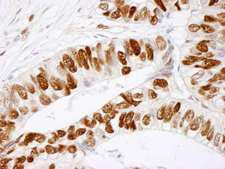 MCM2 Antibody - Detection of Human phospho-MCM2 (Ser 41) by Immunohistochemistry. Sample: FFPE section of human colon adenocarcinoma. Antibody: Affinity purified rabbit anti-Phospho-MCM2 (Ser 41) used at a dilution of 1:100. Detection: DAB.