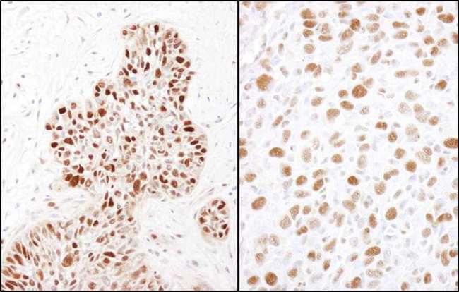 MCM2 Antibody - Detection of Human and Mouse MCM2 (Ser41) by Immunohistochemistry. Sample: FFPE section of human laryngeal squamous cell carcinoma (left) and mouse squamous cell carcinoma (right). Antibody: Affinity purified rabbit anti-MCM2 (Ser41) used at a dilution of 1:1000 (1 ug/ml). Detection: DAB.