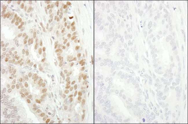 MCM2 Antibody - Detection of Human Phospho-MCM2 (S53) by Immunohistochemistry. Samples: FFPE serial sections of human breast adenocarcinoma. Mock phosphatase treated section (left) or calf intestinal phosphatase treated section (right) immunostained for Phospho-MCM2 (S53). Antibody: Affinity purified rabbit anti-Phospho-MCM2 (S53) used at a dilution of 1:250. Epitope Retrieval Buffer-High pH (IHC-101J) was substituted for Epitope Retrieval Buffer-Reduced pH.