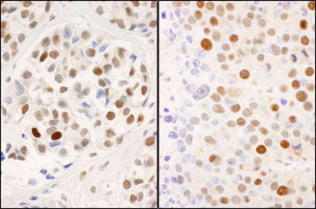 MCM2 Antibody - Detection of Human and Mouse MCM2 (S53) Immunohistochemistry. Sample: FFPE sections of human breast carcinoma (left) and mouse renal cell carcinoma (right). Antibody: Affinity purified rabbit anti-MCM2 (S53) No. Lot4) used at a dilution of 1:200 (1 ug/ml). Detection: DAB.