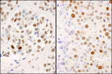 MCM2 Antibody - Detection of Human and Mouse MCM2 (S53) Immunohistochemistry. Sample: FFPE sections of human breast carcinoma (left) and mouse renal cell carcinoma (right). Antibody: Affinity purified rabbit anti-MCM2 (S53) No. Lot4) used at a dilution of 1:200 (1 ug/ml). Detection: DAB.