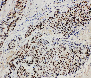 MCM3 Antibody - MCM3 antibody. IHC(P): Human Lung Cancer Tissue.