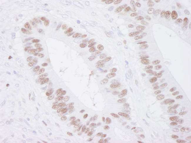 MCM3 Antibody - Detection of Human MCM3 by Immunohistochemistry. Sample: FFPE section of human colon adenocarcinoma. Antibody: Affinity purified rabbit anti-MCM3 used at a dilution of 1:250. Detection: DAB staining using anti-rabbit IHC antibody at a dilution of 1:100.