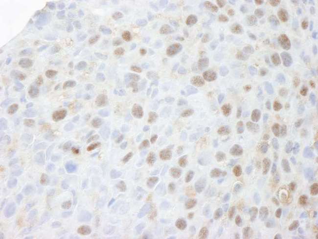MCM3 Antibody - Detection of Mouse MCM3 by Immunohistochemistry. Sample: FFPE section of mouse squamous cell carcinoma. Antibody: Affinity purified rabbit anti-MCM3 used at a dilution of 1:250. Detection: DAB staining using anti-rabbit IHC antibody at a dilution of 1:100.