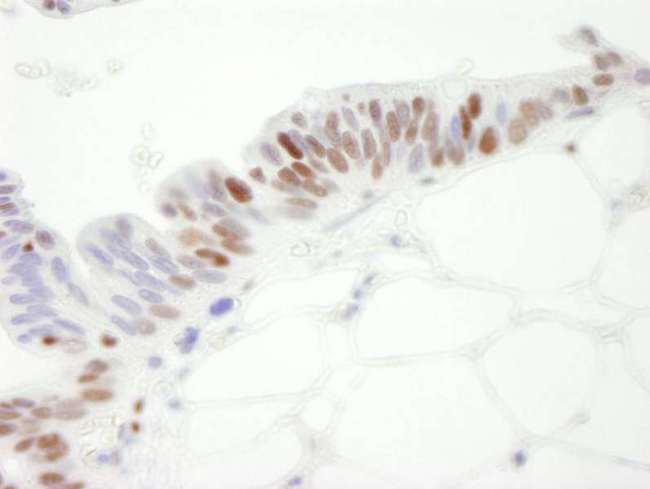 MCM3 Antibody - Detection of Human MCM3 by Immunohistochemistry. Sample: FFPE section of human ovarian tumor. Antibody: Affinity purified goat anti-MCM3 used at a dilution of 1:250. Detection: DAB.
