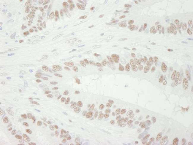 MCM3 Antibody - Detection of Human MCM3 by Immunohistochemistry. Sample: FFPE section of human colon adenocarcinoma. Antibody: Affinity purified goat anti-MCM3 used at a dilution of 1:250. Detection: DAB.