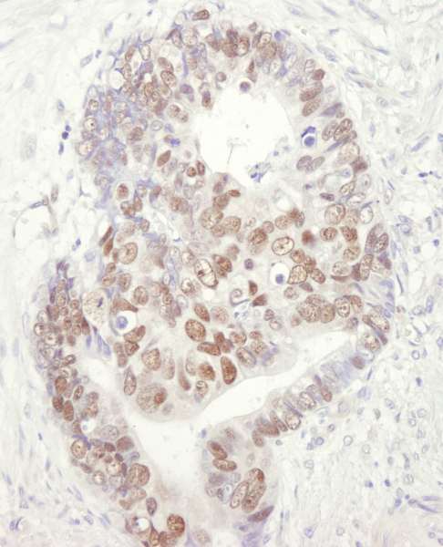 MCM3 Antibody - Detection of Human MCM3 by Immunohistochemistry. Sample: FFPE section of human colon carcinoma. Antibody: Affinity purified goat anti-MCM3 used at a dilution of 1:1000 (1 Detection: DAB.